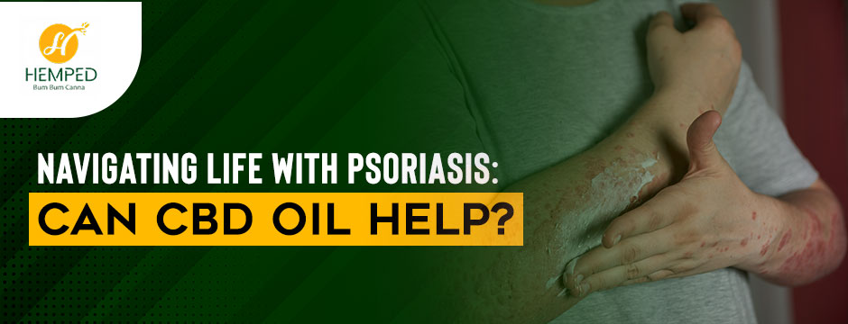 CBD oil for psoriasis